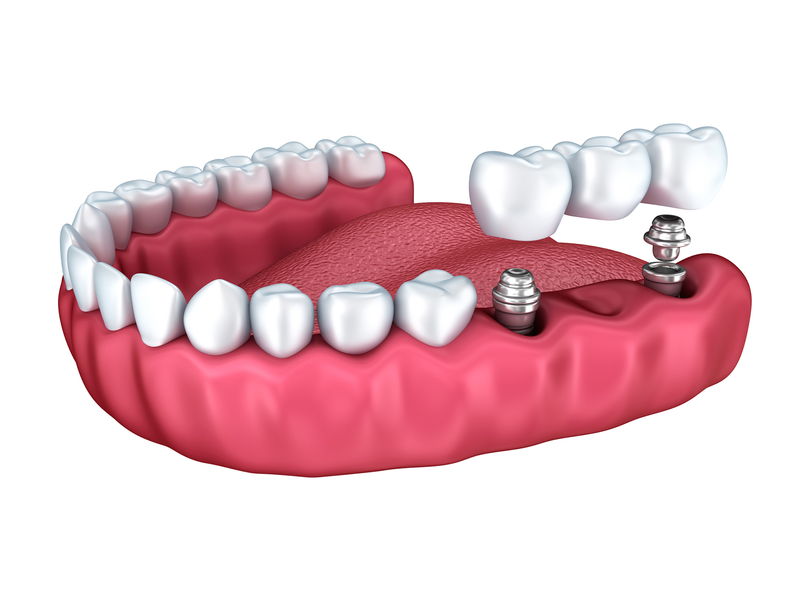 Do gums grow around implants?