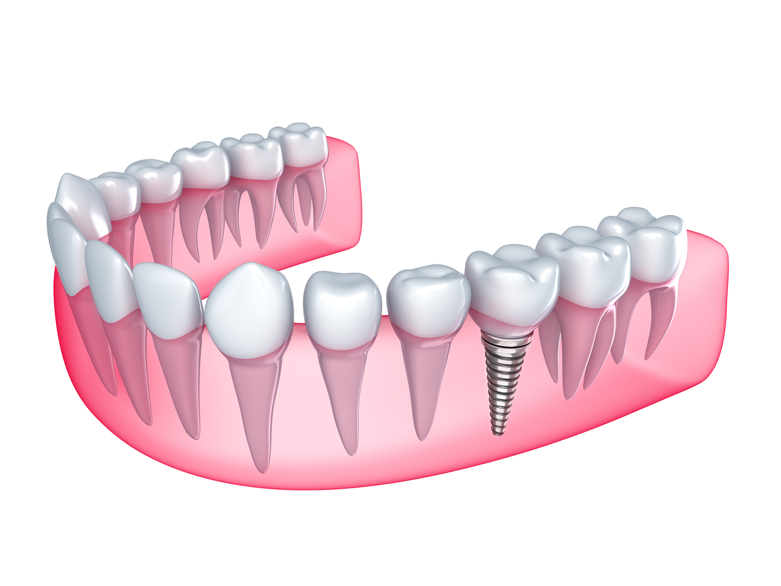 How long do teeth implants last?