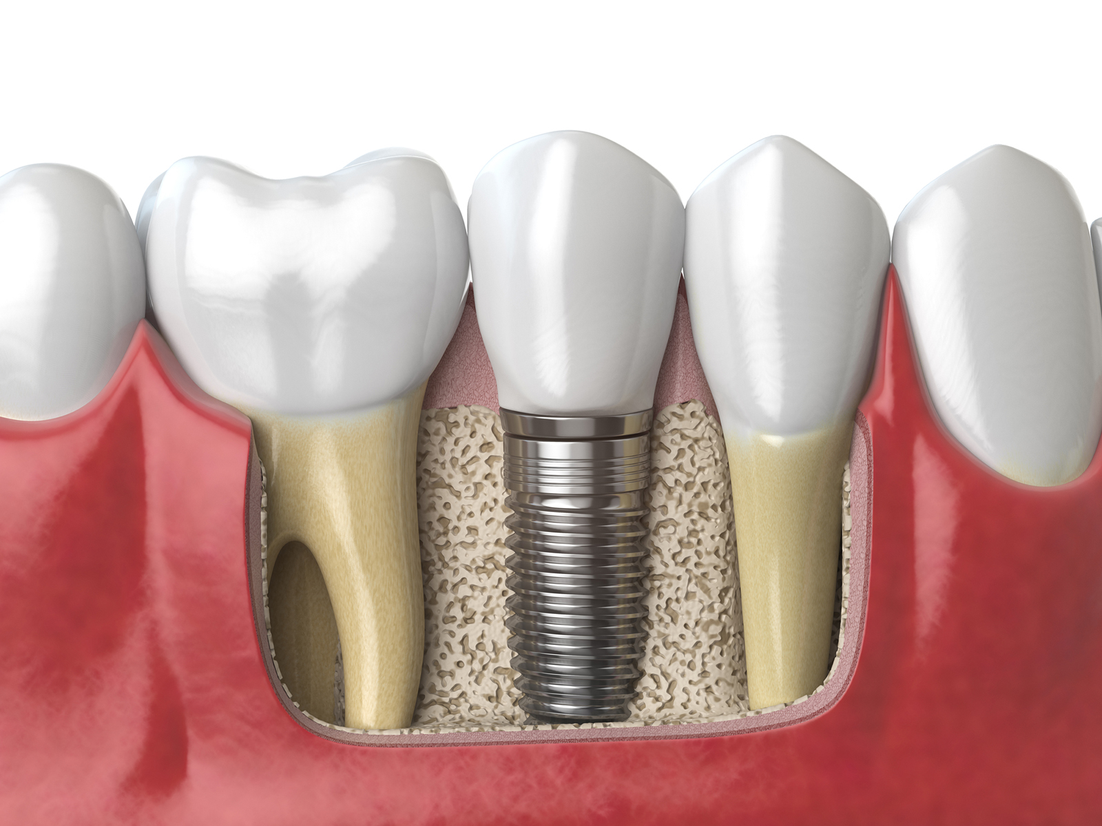 What percentage of dental implants fail?