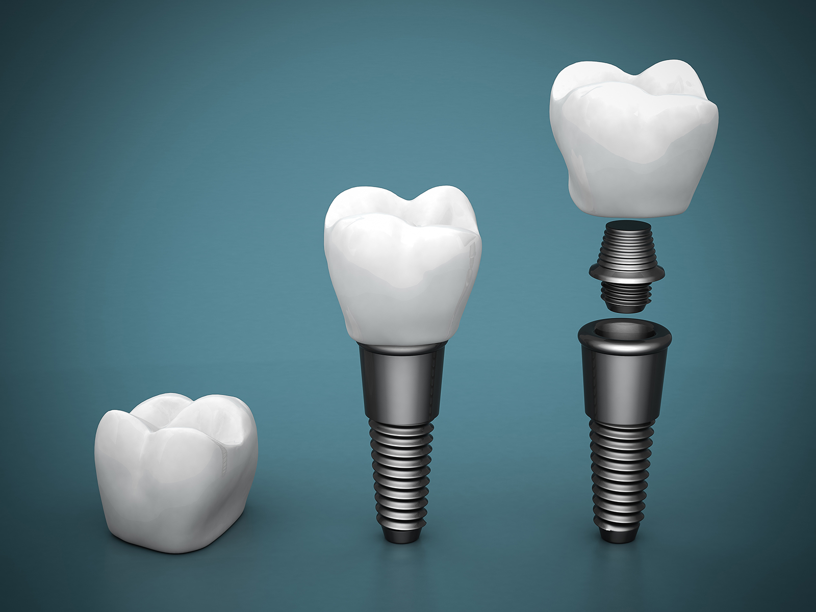 Define Pier Abutment In Dentistry at Sabrina Norris blog