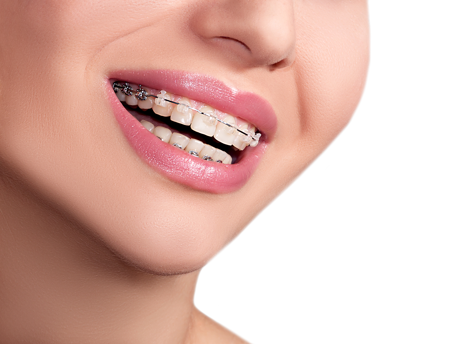 What are gold braces?