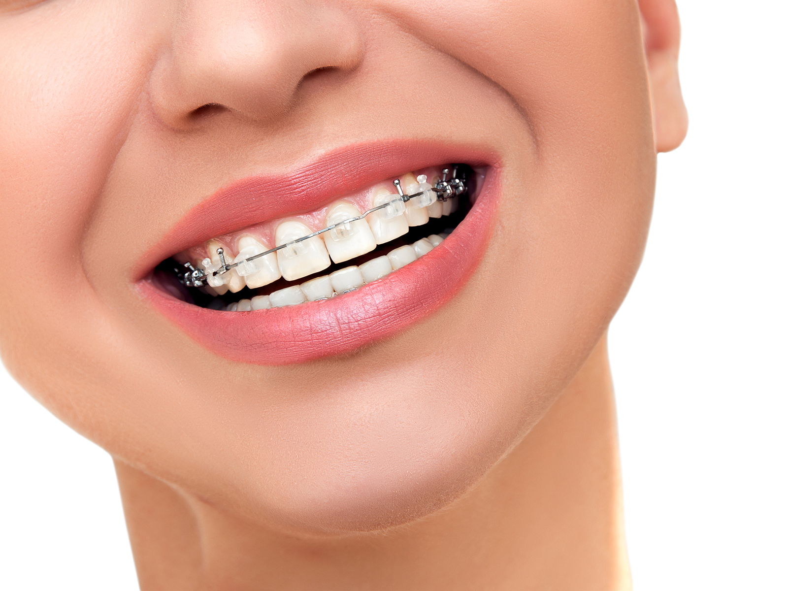 What is the side effect of braces?