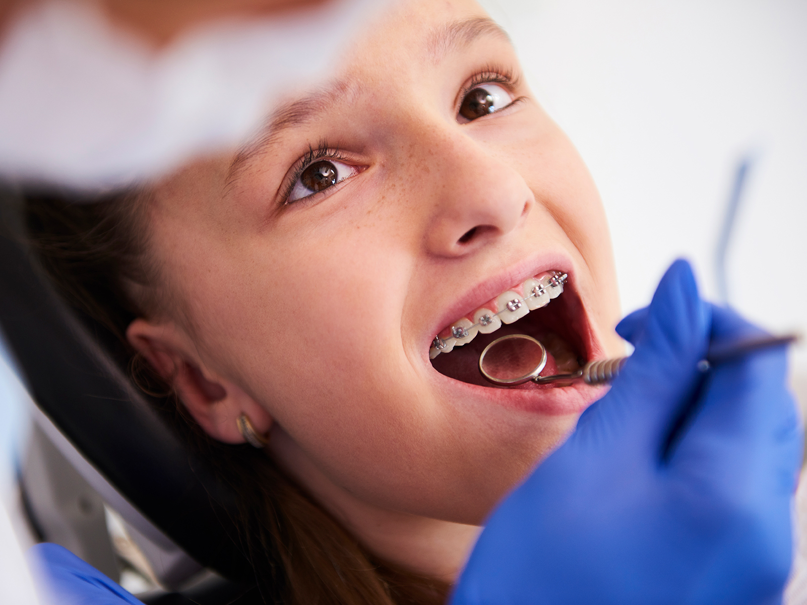 Can A Child Get Braces With Baby Teeth?