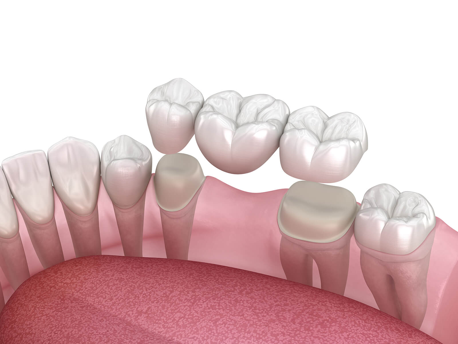 How To Care For Your Dental Bridges: Maintenance Tips For Longevity