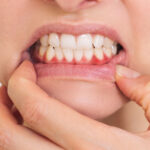 Common Causes of Sore And Inflamed Gums