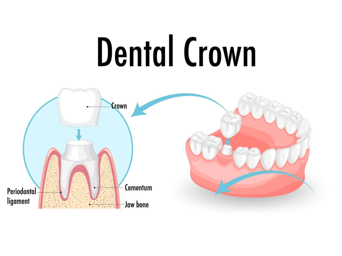 How To Care For Your Dental Crown: Do's And Don’ts