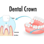 How To Care For Your Dental Crown: Do's And Don’ts