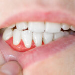 How To Prevent And Treat Gum Recession