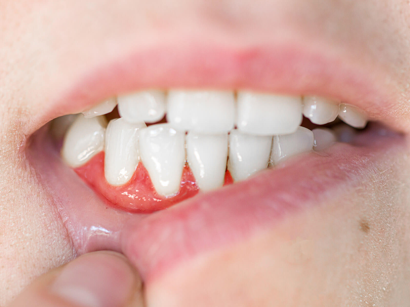 How To Prevent And Treat Gum Recession